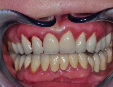 Vnetje dlesni oz. gingivitis