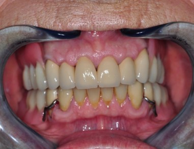 POTEM - Zdrave dlesni