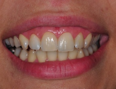 POTEM - Notranje beljenje zoba