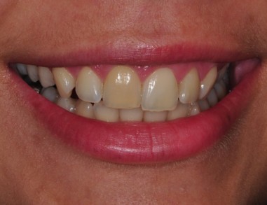 PREJ - Notranje beljenje zoba