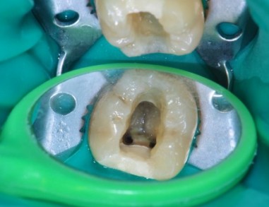 Pogled v notranjost zoba med zdravljenjem