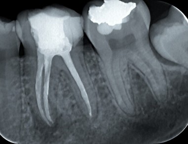 POTEM - Zdravljenje zoba
