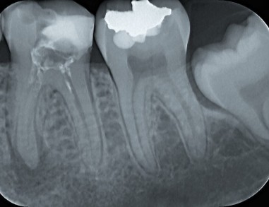 PREJ - Zdravljenje zoba