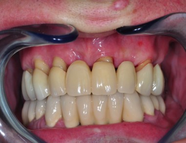 Posledice parodontalne bolezeni
